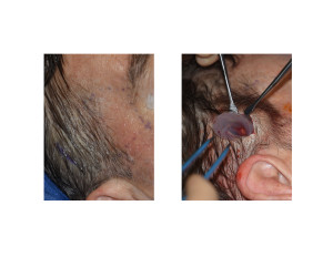 Temporal Implants Incision and Insertion Dr Barry Eppley Indianapolis
