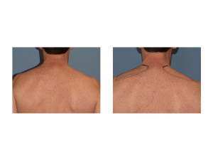 Trapezius Muscle Implants Markings Dr Barry Eppley Indianapolis