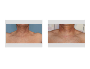 Trapezius Muscle Implants immediate result Dr Barry Eppley Indianapolis