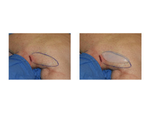 Trapezius Muscle Implants surgical technique Dr Barry Eppley Indianapolis