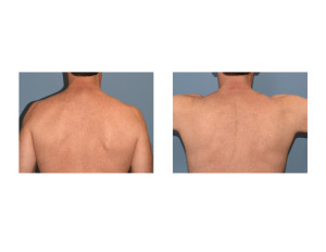 TrapeziusMuscle Implants preop Dr Barry Eppley Indianapolis