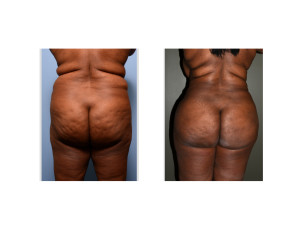 african-american Back and Flank Liposuction result back view Dr Barry Eppley Indianapolis
