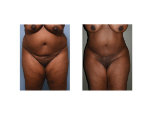 african-american abdominal liposuction result front view Dr Barry Eppley Indianapolis