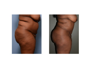 african-american abdominal liposuction result side view Dr Barry Eppley Indianapolis