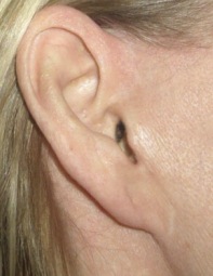 pixie ear deformity