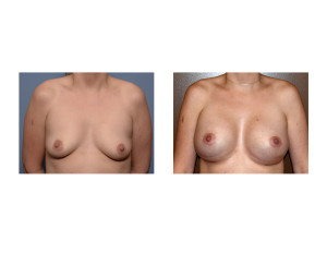 Breast Implant Surgery with IMF lowering results front view Dr Barry Eppley Indianapolis