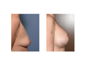 Breast Implant Surgery with IMF lowering results side view Dr Barry Eppley Indianapolis