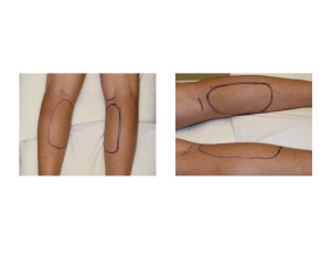 Calf Implant Incisions Dr Barry Eppley Indianapolis