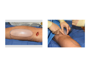 Calf Implant Insertion Technique Dr Barry Eppley Indianapolis