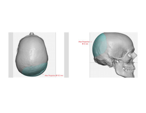 Custom Occipital Implant dimensions Dr Barry Eppley Indianapolis