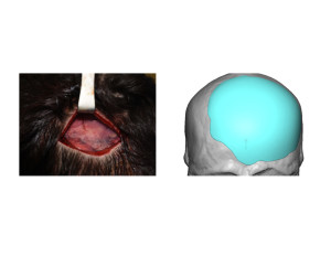 Custom Occipital Implant marker orientation intraop Dr Barry Eppley Indianapolis