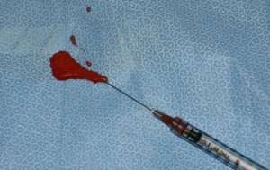 Enhanced Nanofat Injections Dr Barry Eppley Indianapolis
