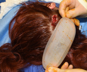 First Stage Scalp Tissue Expander for Large Skull Implant Dr Barry Eppley Indianapolis