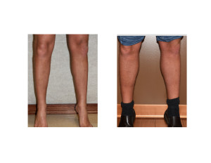 Male Calf Implants result front view raised Dr Barry Eppley Indianapolis