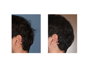 Occipital Skull Implant Dr Barry Eppley Indianapolis