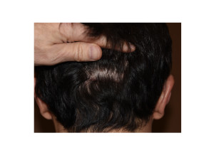Occipital Skull Implant incision Dr Barry Eppley Indianapolis