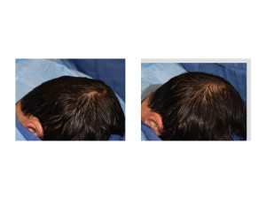 Occipital Skull Implant intraop oblique result Dr Barry Eppley Indianapolis