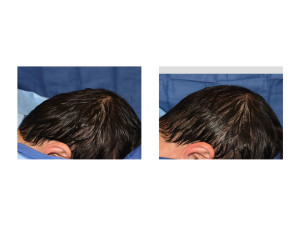 Occipital Skull Implant intraop side view result Dr Barry Eppley Indianapolis