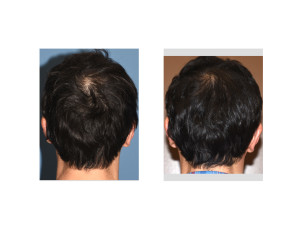 Occipital Skull Implant result back view Dr Barry Eppley Indianapolis