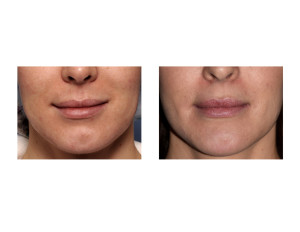 Perioral Mound Liposuction result front view Dr Barfry Eppley Indianapolis