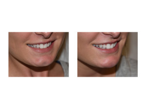 Positive Saline Injection Test for Cheek Dimple Reduction Dr Barry Eppley Indianapolis
