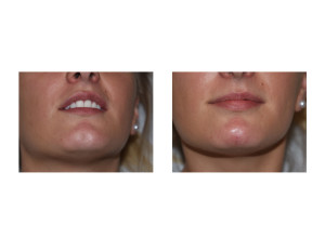 Postive Saline Injection Test for Chin Dimple Treatment Dr Barry Eppley Indianapolis