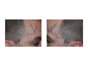 Temporal Arter Ligation incisions Dr Barry Eppley Indianapolis