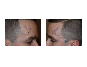 Temporal Artery Ligation Dr Barry Eppley Indianapolis