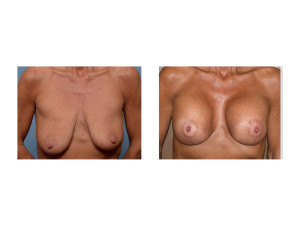 weight loss BAM LIft results front view Dr Barry Eppley Indianapolis