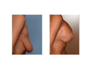 weight loss BAM Lift result side view Dr Barry Eppley Indianapolis