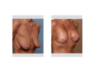 weight loss BAM Lift results oblique view Dr Barry Eppley Indianapolis