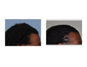 A Sagittal Ridge Skull Reduction result side view Dr Barry Eppley Indianapolis