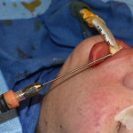 Buccal Fat Injections to Lips Dr Barry Eppley Indianapolis
