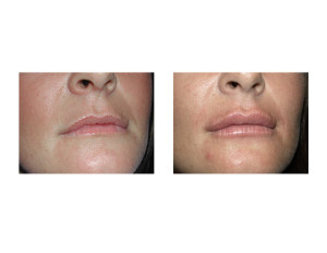 Buccal Fat Lip Injections result Dr Barry Eppley Indianapolis