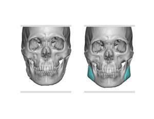 Custom Jaw Angle Implants for Jaw Angle Restoration front view Dr Barry Eppley Indianapolis