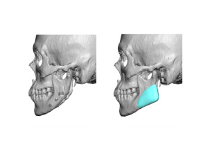 Custom Jaw Angle Implants for Jaw Angle Restoration left side Dr Barry Eppley Indianapolis