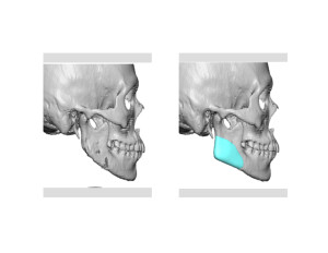 Custom Jaw Angle Implants for Jaw Angle Restoration right side Dr Barry Eppley Indianapolis