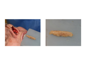 Diced Rib Graft Rhinoplasty Dr Barry Eppley Indianapolis