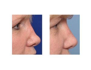 Diced Rib Graft Rhinoplasty result side view Dr Barry Eppley Indianapolis
