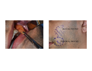 Facial Effects of Buccal Lipectomy Dr Barry Eppley Indianapolis
