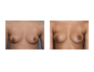 Fat Injection Breast Augmentation result front view Dr Barry Eppley Indianapolis