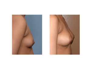 Fat Injection Breast Augmentation result side view Dr Barry Eppley Indianapolis
