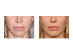 Female Jaw Angle Implants result front view Dr Barry Eppley Indianapolis