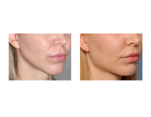 Female Jaw Angle Implants result oblique view Dr Barry Eppley Indianapolis