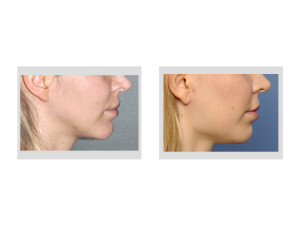 Female Jaw Angle Implants result side view Dr Barry Eppley Indianapolis