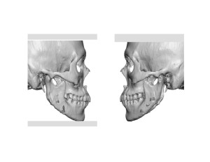 Jaw Angle Reductions with Medpor Impplant Reconstruction Dr Barry Eppley Indiianapolis