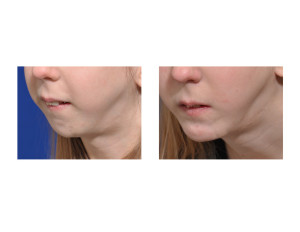 Jumping Sliding Genioplasty result oblique view Dr Barry Eppley Indianapolis