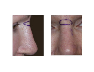 Nasal Lift Excision Pattern Dr Barry Eppley Indianapolis