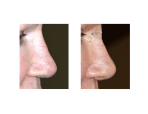 Nasal Lift result Dr Barry Eppley Indianapolis