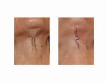 Neck Z Plasty Scar Revision Dr Barry Eppley Indianapolis
